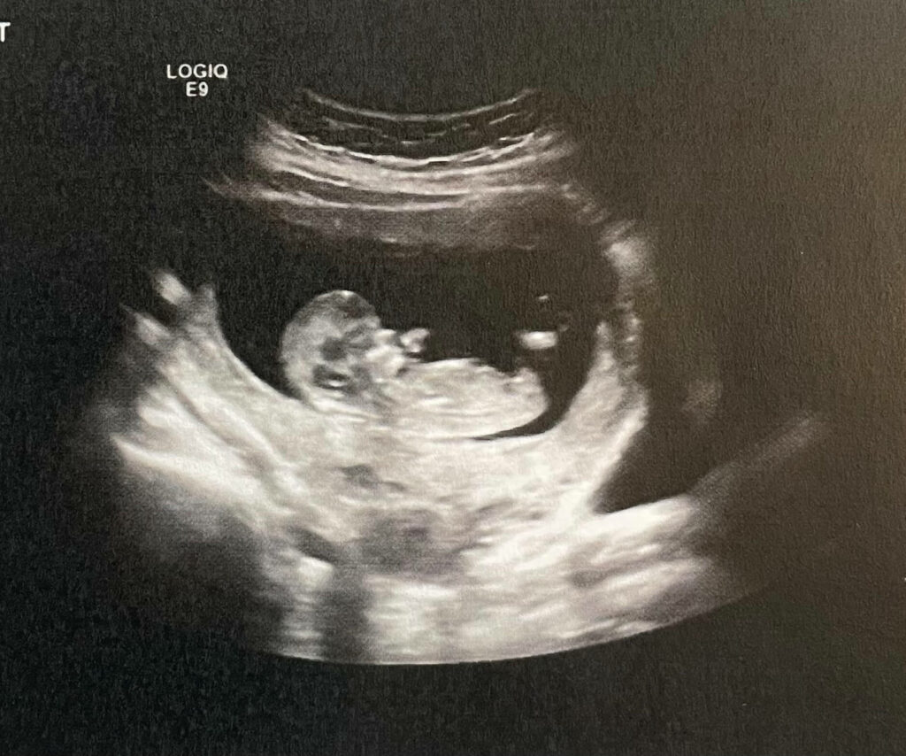 niche twins ultrasound month 33 update site 1
